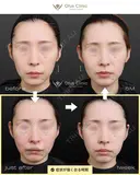 裏側人中短縮 before画像 サムネイル用