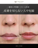 裏側人中短縮 180日後 サムネイル用