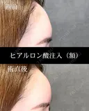 ヒアルロン酸注入（額） before画像 サムネイル用