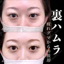 裏ハムラ 180日後 サムネイル用