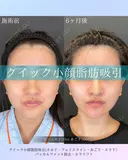 クイック小顔脂肪吸引・バッカルファット除去・ルラリフト before画像 サムネイル用