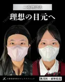 Dr浦野執刀🎀二重埋没法 before画像 サムネイル用