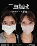 Dr岩切🎀二重埋没🎀 30日後 サムネイル用