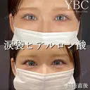【🧸涙袋ヒアルロン酸🧸】 after画像 サムネイル用