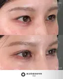 二重埋没法 before画像 サムネイル用