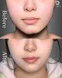 顔（アゴ下・頬）の脂肪吸引、エラボトックス、アゴボトックス、アゴのヒアルロン酸注入 before画像 サムネイル用