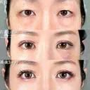 目の下のクマ取り/脂肪注入(目の下・ゴルゴライン) before画像 サムネイル用