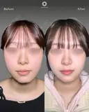 顔（アゴ下・頬）の脂肪吸引、エラボトックス、アゴボトックス、アゴのヒアルロン酸注入 before画像 サムネイル用