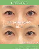 目の下の食い込みの治し方 before画像 サムネイル用