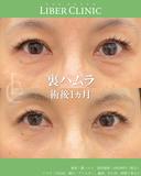 目の下の食い込みの治し方 0日後 サムネイル用