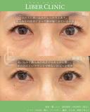 目の下の食い込みの治し方 after画像 サムネイル用