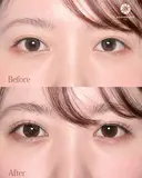 涙袋ヒアルロン酸 before画像 サムネイル用