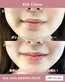自然に叶う！理想のうるつやリップ！ before画像 サムネイル用