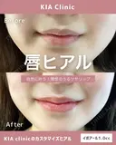 自然に叶う！理想のうるつやリップ！ after画像 サムネイル用