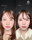 涙袋ヒアルロン酸、美肌スレッド（糸によるリフトアップ）、ジョールファット除去、エラボトックス 60日後 サムネイル用
