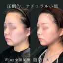 Wing小顔女神脂肪吸引 30日後 サムネイル用