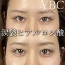 【🍑涙袋ヒアルロン酸🍑】 before画像 サムネイル用