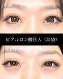 ヒアルロン酸注入（涙袋） before画像 サムネイル用