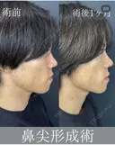鼻尖形成術クローズ法 after画像 サムネイル用