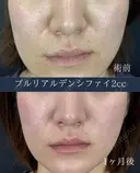 プルリアルデンシファイ2cc before画像 サムネイル用