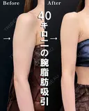 ベイザー併用アキーセル二の腕脂肪吸引 before画像 サムネイル用