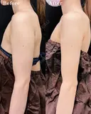 ベイザー併用アキーセル二の腕脂肪吸引 180日後 サムネイル用