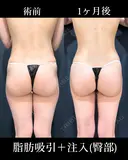 豊尻 before画像 サムネイル用