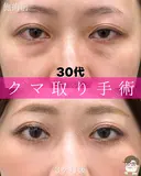 目の下のふくらみ取り・脂肪注入 after画像 サムネイル用