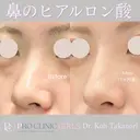 妥協は許さない🤷流れにくいヒアルロン酸で注入後から綺麗な仕上がりを維持✨【クレヴィエル】使用 before画像 サムネイル用