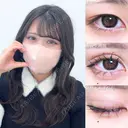 アリエルクイックループトリプル二重埋没法/涙袋ヒアルロン酸 7日後 サムネイル用