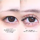 アリエルクイックループトリプル二重埋没法/涙袋ヒアルロン酸 before画像 サムネイル用