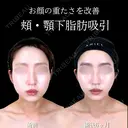 頬・顎下脂肪吸引/ジョールファット/糸リフト  180日後 サムネイル用