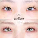 アリエルクイックループダブル二重埋没法 before画像 サムネイル用