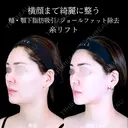 頬・顎下脂肪吸引/ジョールファット除去/糸リフト before画像 サムネイル用