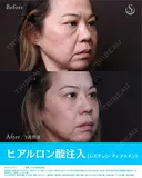 ヒアルロン酸注入　レスチレンデファイン　(ほうれい線・マリオネットライン) before画像 サムネイル用