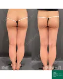 カリカリボディを目指す🌴コンプリート脂肪吸引【大腿全周臀部一部含む】形成外科専門医がご対応 before画像 サムネイル用