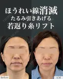 脂肪吸引×糸リフト before画像 サムネイル用