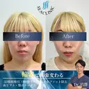 ３D脂肪吸引（頬・顎下）/ジョールファット除去/糸リフト/顎ボトックス after画像 サムネイル用