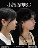岩切医師による🔥小顔脂肪吸引🔥 before画像 サムネイル用