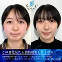 ３D脂肪吸引（頬・顎下）/ジョールファット除去/メーラーファット除去/糸リフト/バッカルファット除去/エラボトックス/顎ヒアルロン酸 after画像 サムネイル用