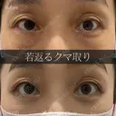 岩切医師による🔥クマ取り🔥 30日後 サムネイル用