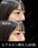 ヒアルロン酸注入 after画像 サムネイル用
