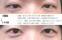 目頭切開法 before画像 サムネイル用