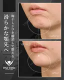 ヒアルロン酸注入（顎）・ボトックス（顎） 14日後 サムネイル用