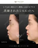 ヒアルロン酸注入（顎）・ボトックス（顎） before画像 サムネイル用
