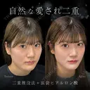 二重埋没法・涙袋ヒアルロン酸 14日後 サムネイル用
