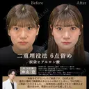 二重埋没法・涙袋ヒアルロン酸 before画像 サムネイル用