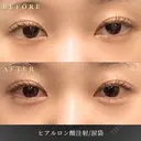 涙袋ヒアルロン酸 after画像 サムネイル用