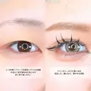  二重埋没 アリエルクイックループトリプル裏留め/涙袋ヒアルロン酸 before画像 サムネイル用