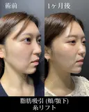 脂肪吸引 after画像 サムネイル用